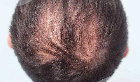 Everything you need to know about scarring alopecia